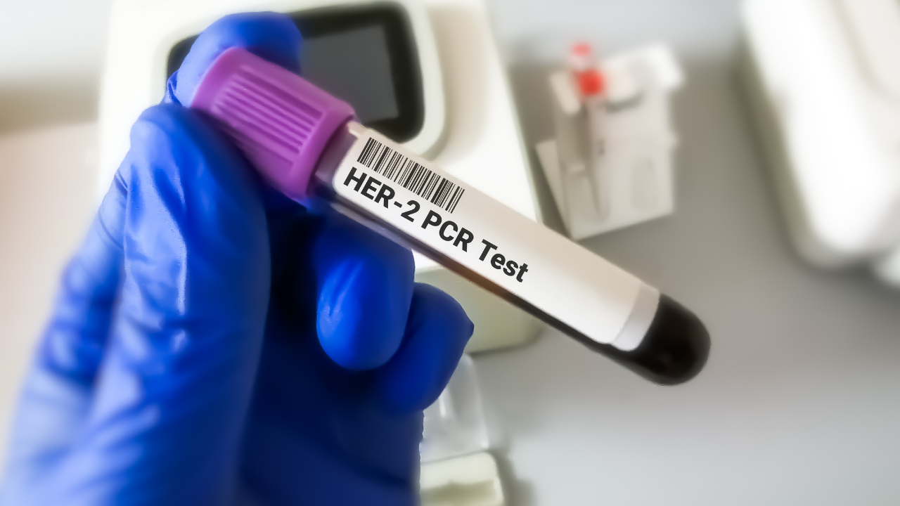 Blood sample for Her-2 or human epidermal growth factor receptor 2 PCR testing for breast cancer diagnosis. Image Credit: Adobe Stock Images/Saiful52