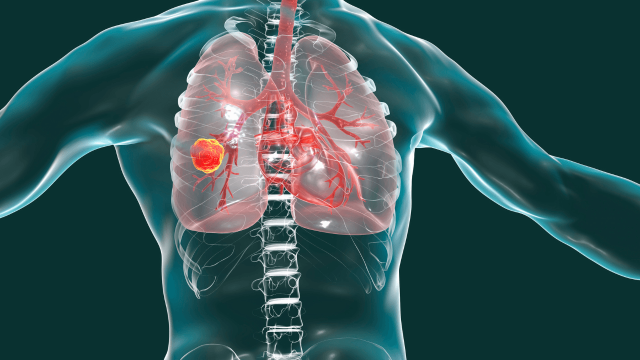 Lung cancer, medical concept, 3D illustration showing cancerous tumor inside human lung. Image Credit: Adobe Stock Images/Dr_Microbe