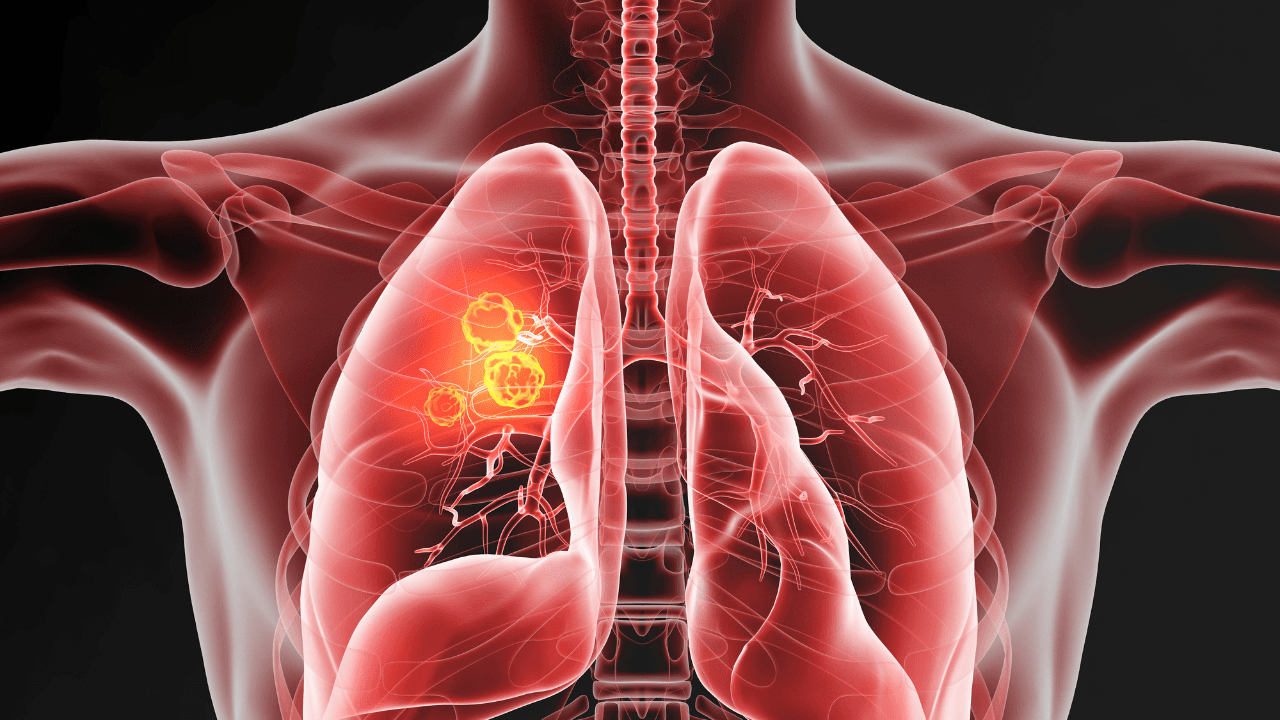 Lung cancer, medically accurate 3D illustration. Image Credit: Adobe Stock Images/Axel Kock