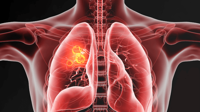 Zongertinib Demonstrates High Objective Response Rate in Previously Treated Advanced Non-Small Cell Lung Cancer 