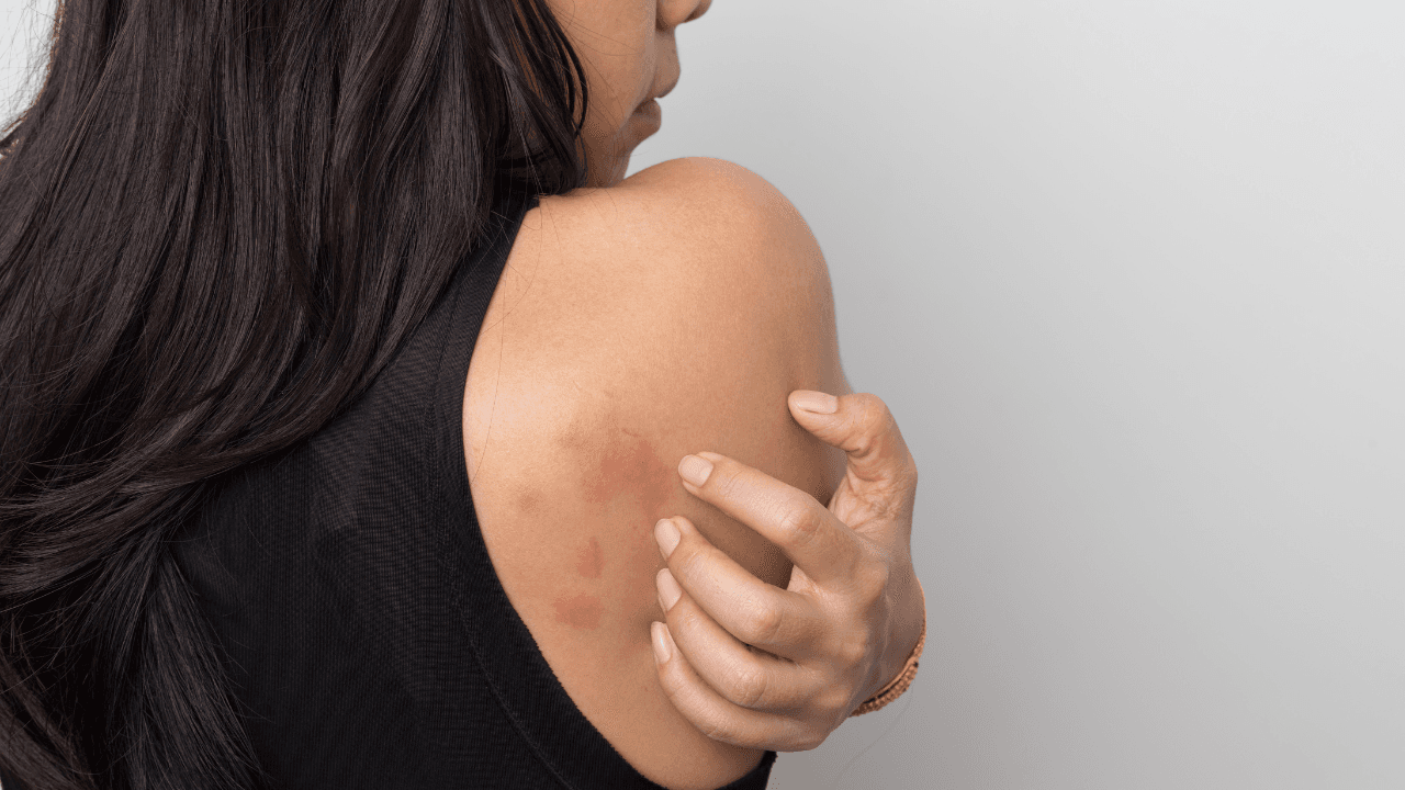 woman showing her skin itching behind , with allergy rash urticaria symptoms. Image Credit: Adobe Stock Images/suriya