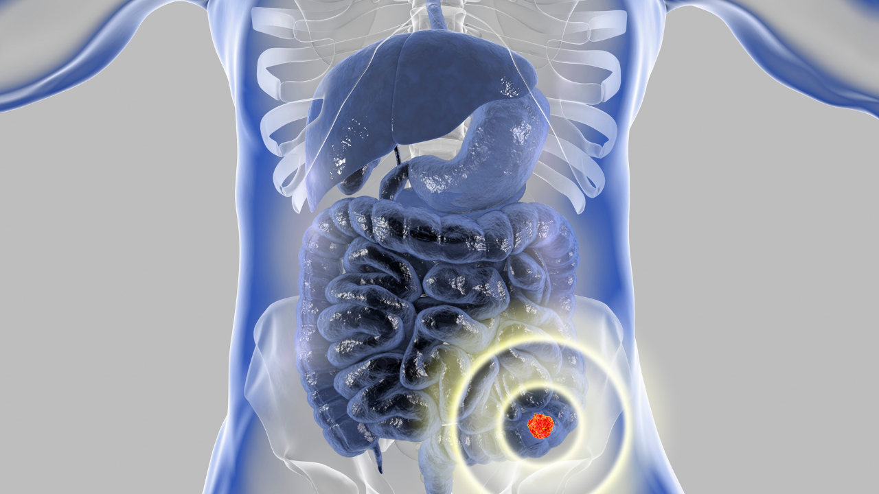 Colorectal cancer awareness medical concept. Concept of cancer treatment and prevention, 3D illustration. Image Credit: Adobe Stock Images/Dr_Microbe 