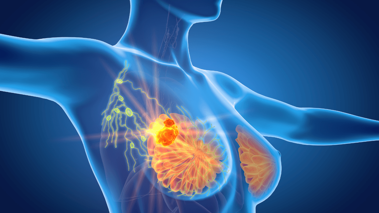 Breast cancer with lymphatics, medically 3D illustration. Image Credit: Adobe Stock Images/Axel Kock