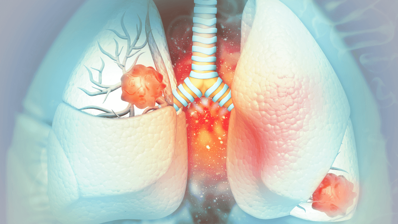 Lung cancer. lung disease. 3d illustration. Image Credit: Adobe Stock Images/Crystal light