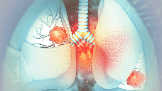 FDA Approves Rybrevant for Locally Advanced, Metastatic Epidermal Growth Factor Receptor Mutated Non-Small Cell Lung Cancer 