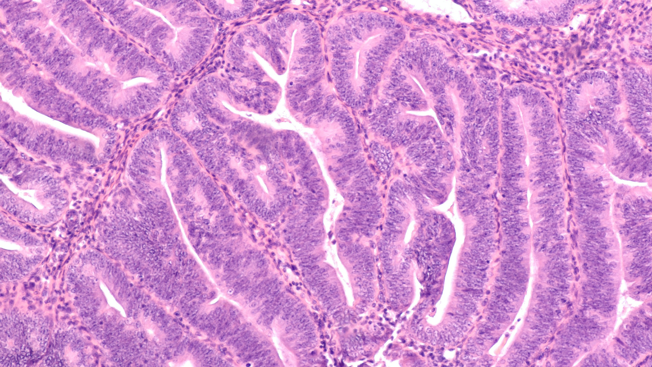 Microscopic image (photomicrograph) of complex endometrial hyperplasia with atypia, from a dilation and curettage specimen (D&C) of a woman with dysfunctional uterine (vaginal) bleeding. Image Credit: Adobe Stock Images/David A. Litman