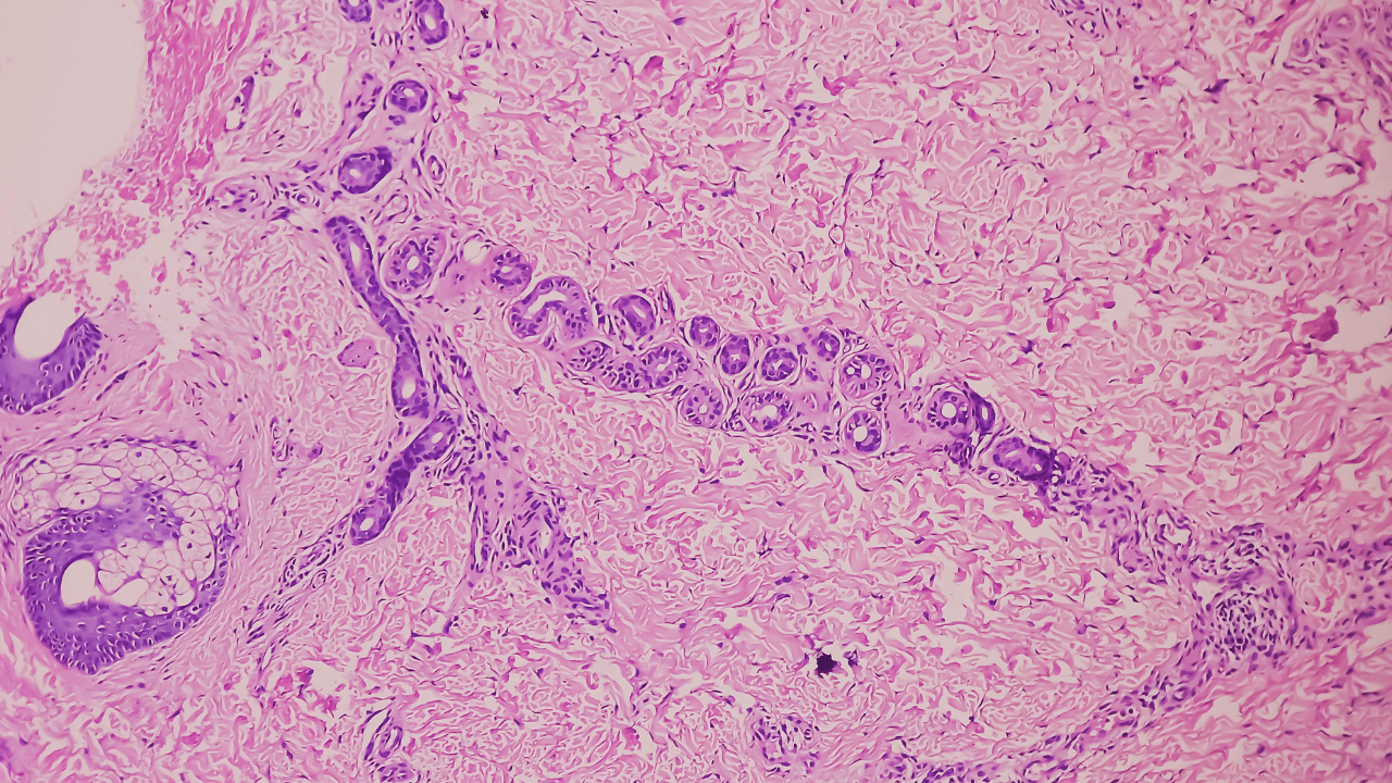 Hand skin tissue (biopsy) : Prurigo nodularis. Microscopically show skin and hyperkeratosis, acanthosis, hypergranulosis, fibroblasts. Image Credit: Adobe Stock Images/MdBabul