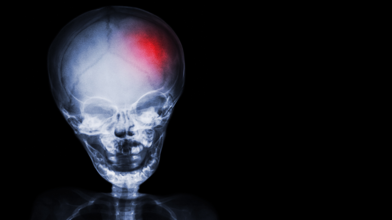 Stroke . film x-ray skull and body of child with red color at head . Neurological concept. Image Credit: Adobe Stock Images/stockdevil