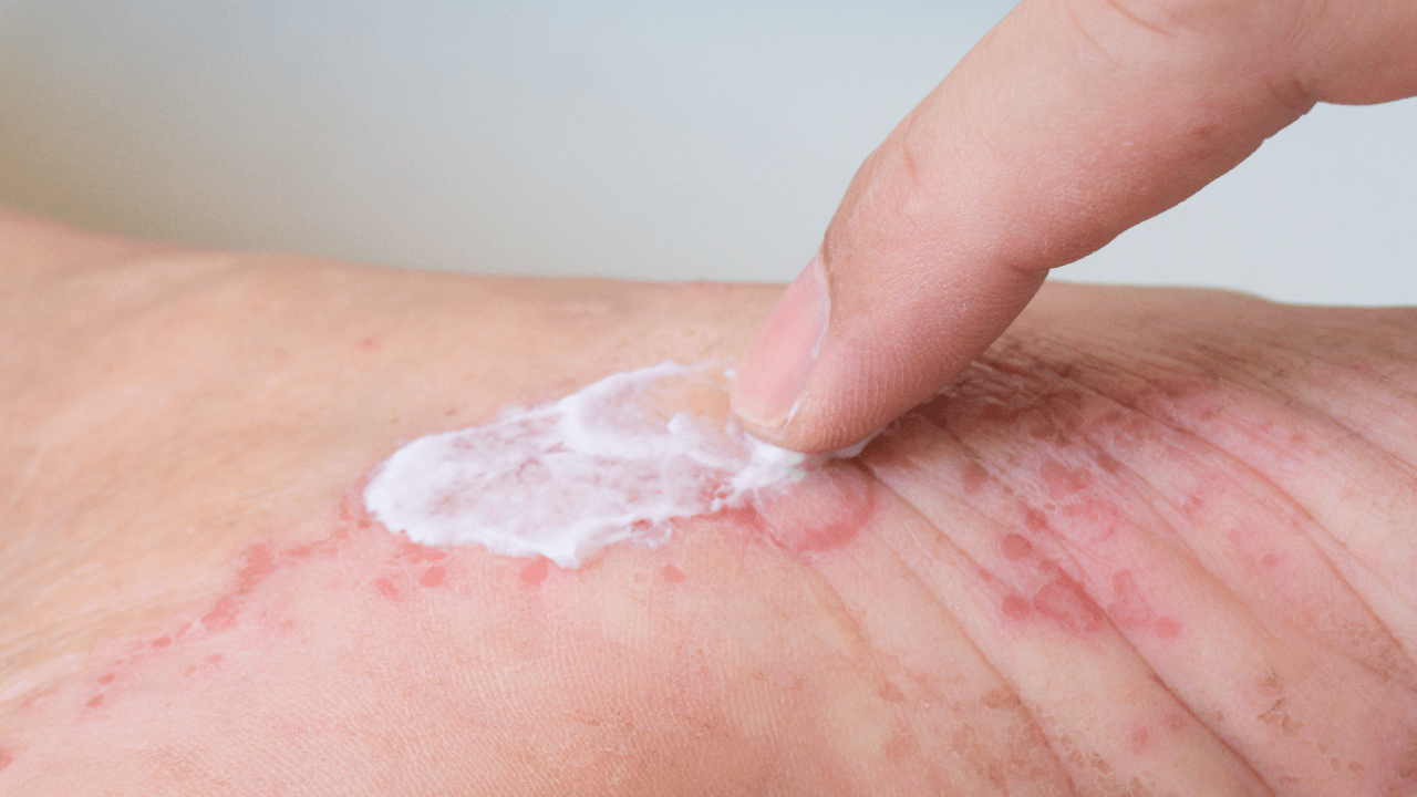 Applying topical steroid ointment to a contact dermatitis skin rash.Atopic dermatitis or atopic eczema, is a type of inflammation of the skin at foot. Image Credit: Adobe Stock Images/chatuphot