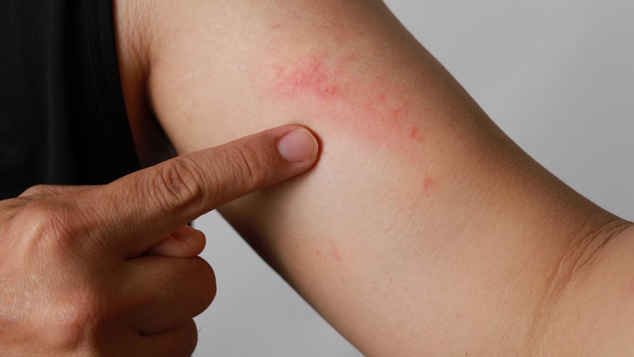 Close up dermatitis on the skin, ill allergic rash dermatitis eczema skin of a patient, atopic dermatitis symptom skin detail texture. Fungus of human skin. Image Credit: Adobe Stock Images/Ityuan