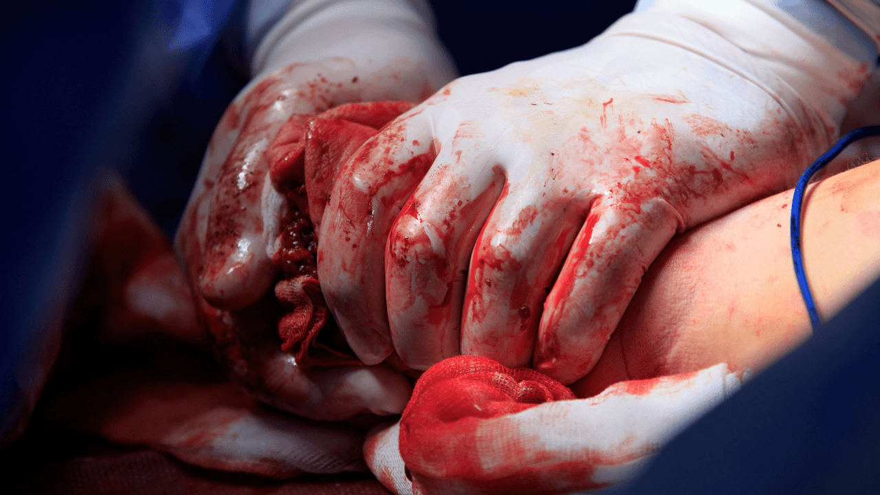 Surgeon hands in bloodstained gloves presses the stump after amputation to stop bleeding close up. Image Credit: Adobe Stock Images/vzmaze