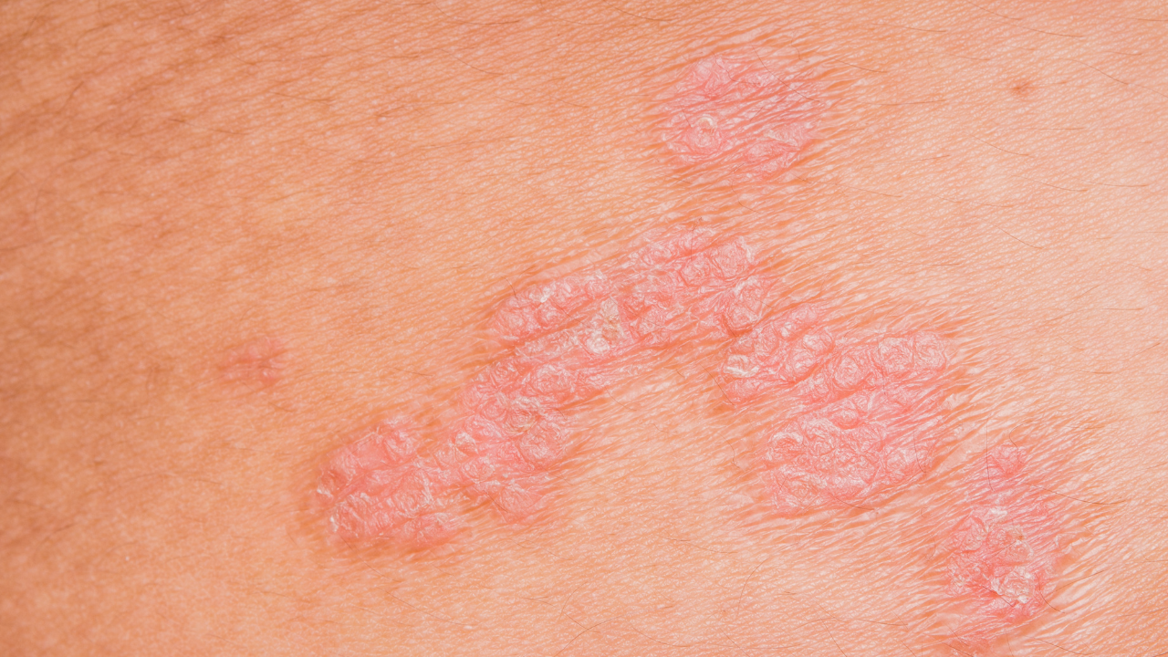 Psoriasis skin. Image Credit: Adobe Stock Images/THONGCHAI