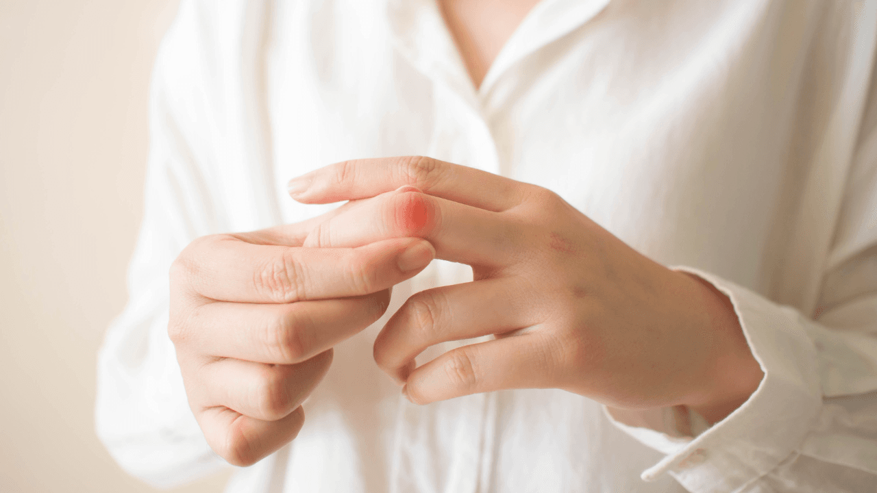 Young female​ suffering from hand and finger joint pain​ with​ redness.​ Cause of pain include rheumatoid arthritis, carpal tunnel syndrome, trigger finger or gout. Health care and medical concept. Image Credit: Adobe Stock Images/Orawan