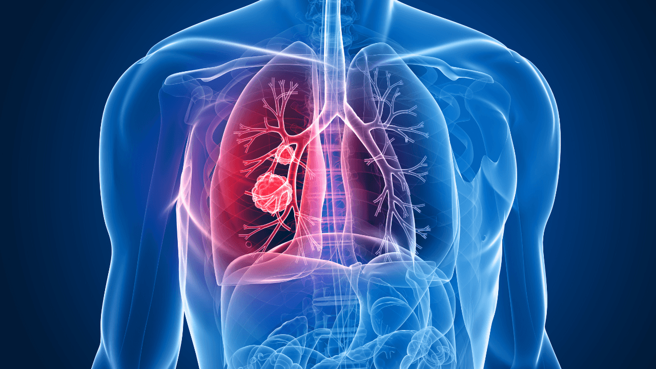 FDA Approves Tagrisso for Unresectable Stage III Epidermal Growth Factor Receptor-Mutated Non-Small Cell Lung Cancer 