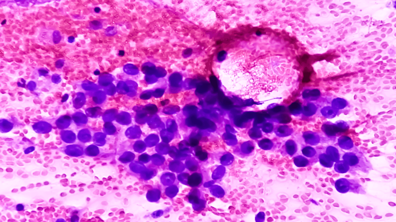  Licensed  Save to Library  Preview Crop  Find Similar   FILE #:  579812705 Photomicrograph of fine needle aspiration (FNA) cytology of a pulmonary (lung) nodule showing adenocarcinoma, a type of non small cell carcinoma. Image Credit: Adobe Stock Images/Saiful52