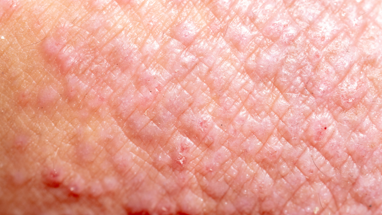 Atopic dermatitis (AD), also known as atopic eczema, is a type of inflammation of the skin (dermatitis). Image Credit: Adobe Stock Images/sinhyu